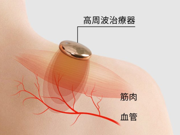 高周波は、血管に作用 無刺激